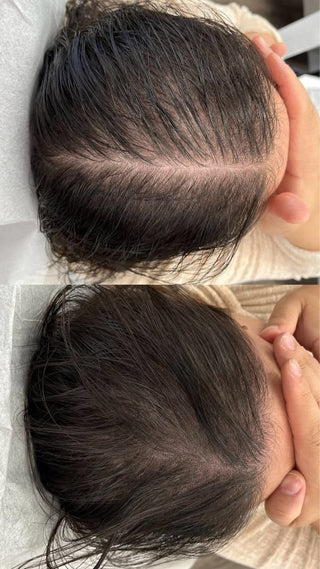 INTENSIVE HAIRLOSS THERAPY
