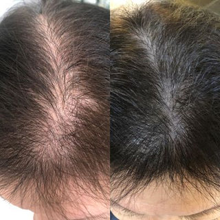 INTENSIVE HAIRLOSS THERAPY